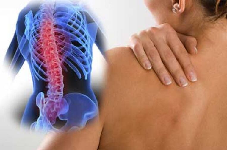 Cu osteocondroză, durerea poate radia în zone îndepărtate ale corpului