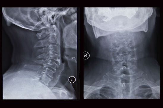 Radiografia coloanei cervicale (pacientul are osteocondroză)