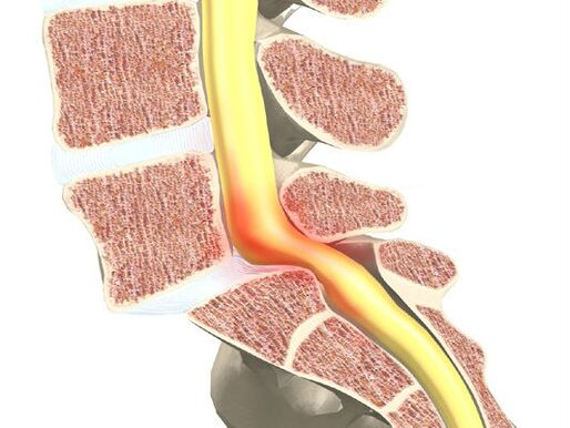 Segment motor de sânge pentru osteochondroză