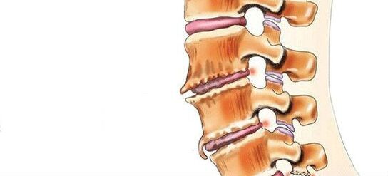 Spondiloză - Distrugerea articulațiilor pivotante intermediare