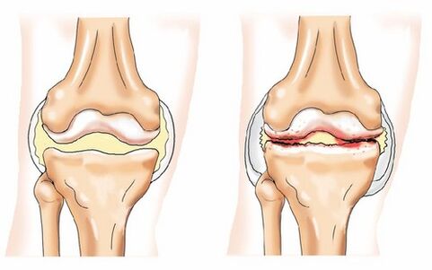 Articulații sănătoase și osteoartrită