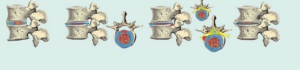 Diferite etape ale osteochondrozei toracice