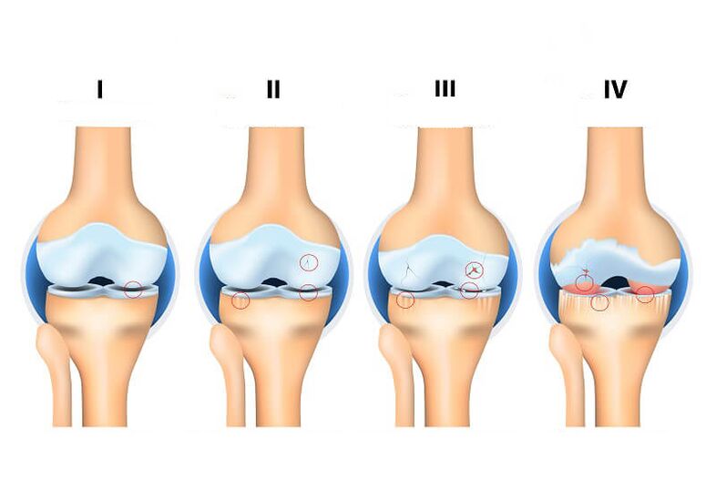 Etapele osteoartritei articulare