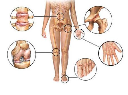 Osteoartrita afectează diferite articulații