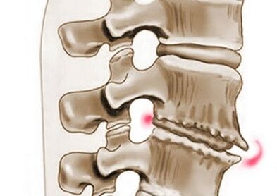 Leziuni ale vertebrelor în osteocondroza toracică