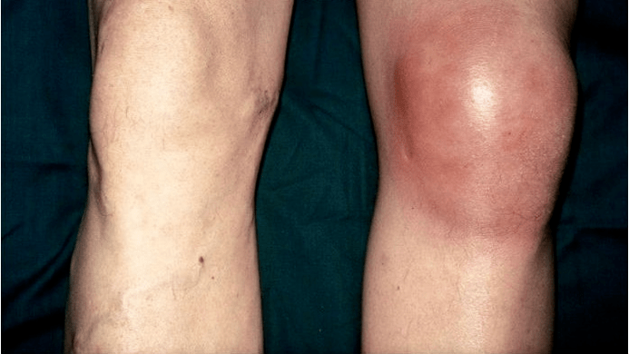 Osteoartrita si artrita