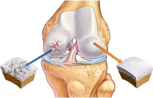 cartilaj sănătos și cartilaj afectat de osteoartrita