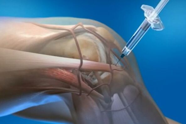 injecții intraarticulare pentru osteoartrita articulației genunchiului
